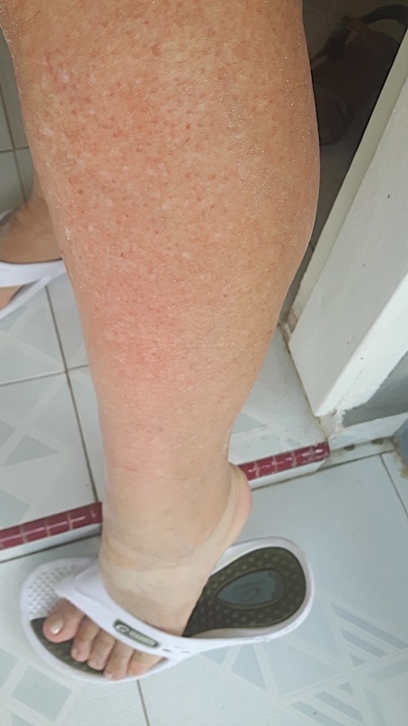 Langkawi - Cenang - piqûre de méduse